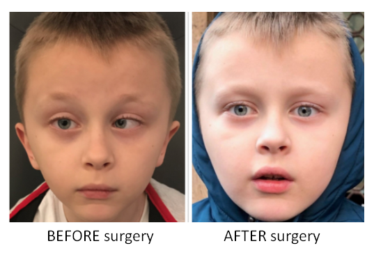 Strabismus Surgery dubai