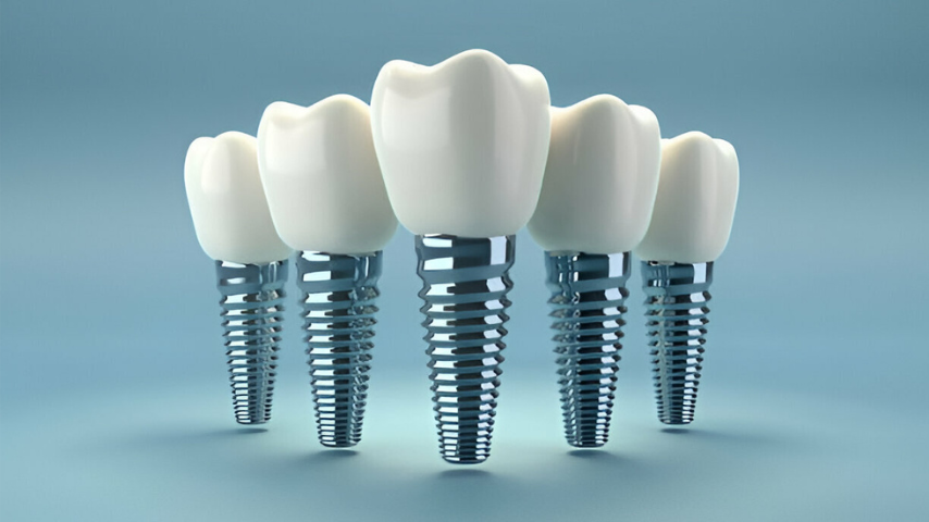 All-on-4 Implants Aberdeen