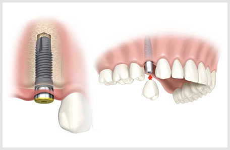 Single Implants Aberdeen